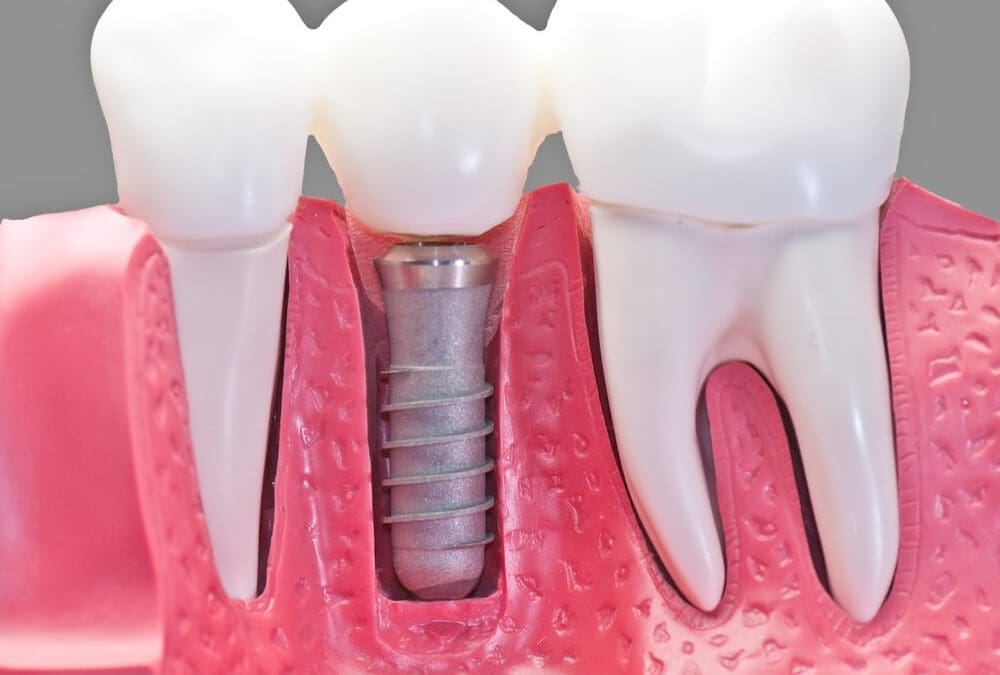 Will Dental Implants Really Work If My Teeth Fell Out?