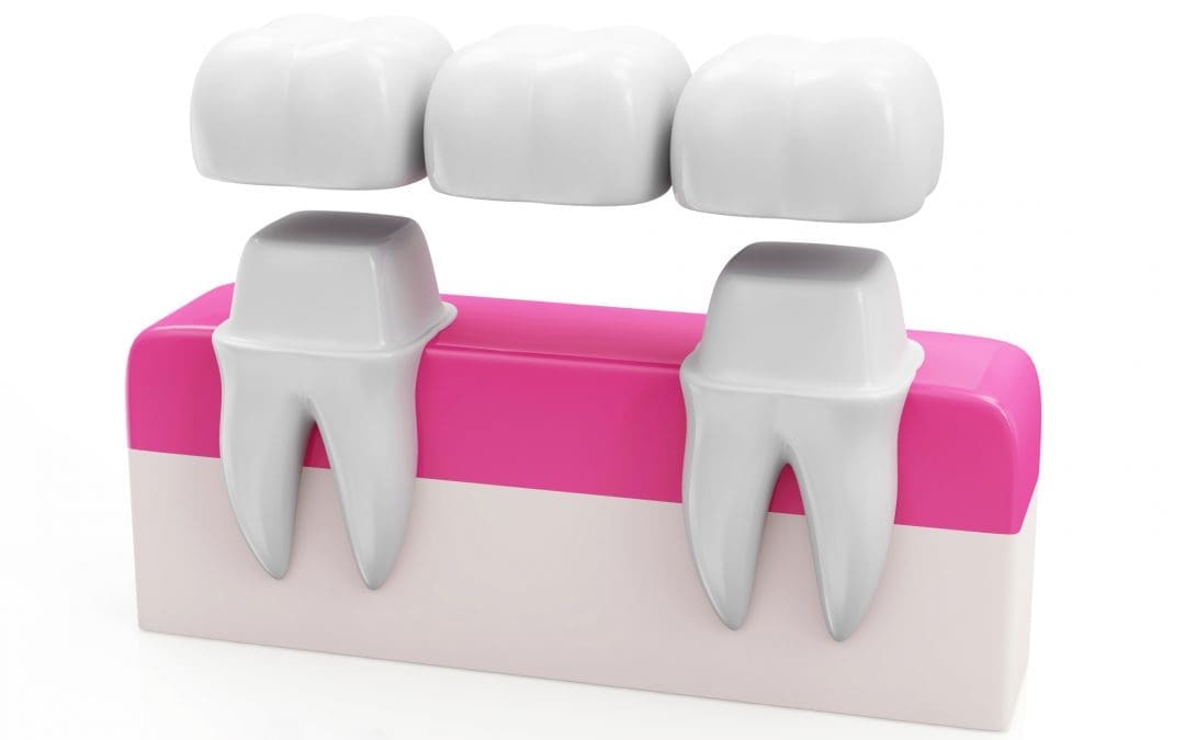 What Does a Dental Bridge Do?